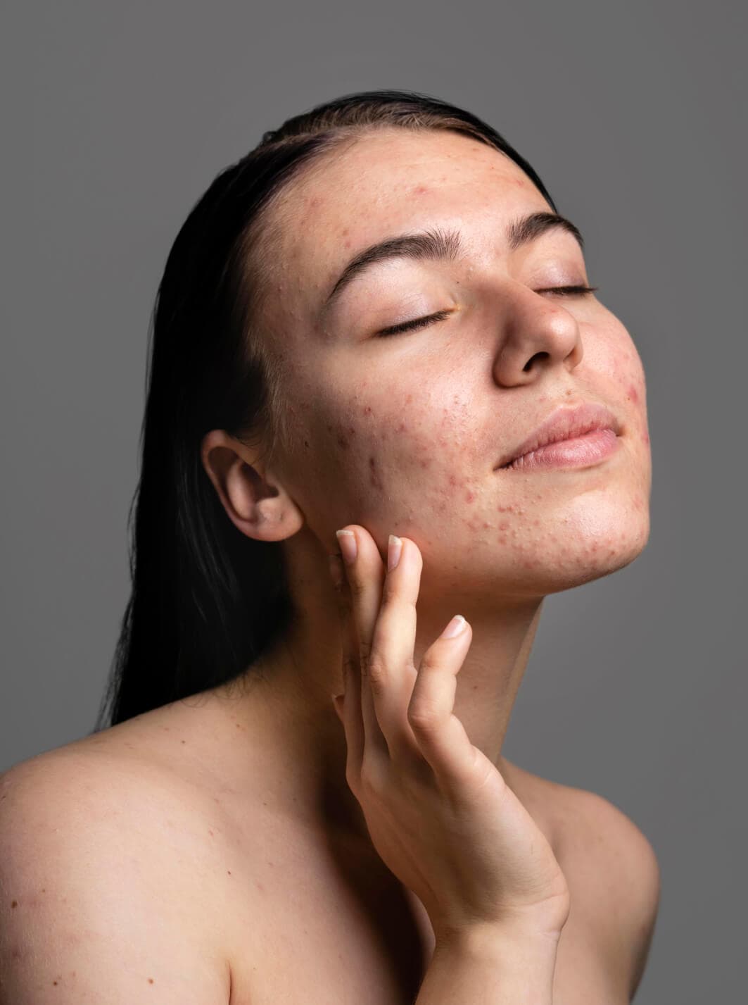 Cicatrizes de Acne e Pós-Cirurgia